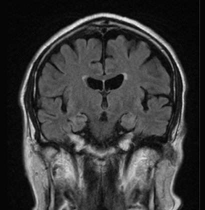 アルツハイマー病のMRI